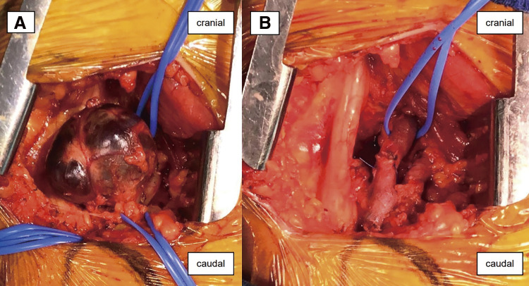 A Case of Popliteal Venous Aneurysm Diagnosed after Sudden Cardiac Arrest.