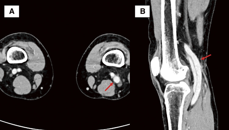 A Case of Popliteal Venous Aneurysm Diagnosed after Sudden Cardiac Arrest.