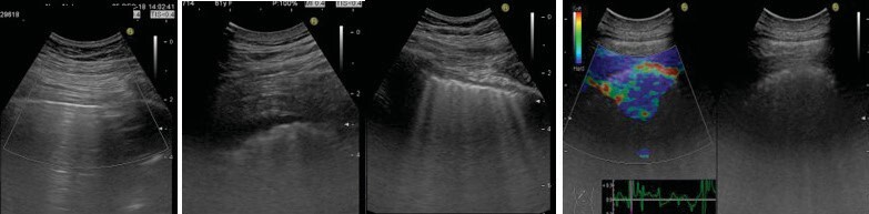 The role of lung ultrasound and ultrasound elastography in diagnosis of interstitial lung diseases.