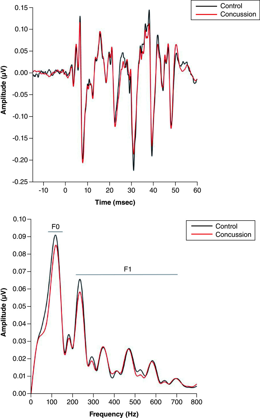 Persistent post-concussion symptoms include neural auditory processing in young children.