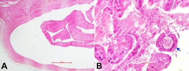 Incidental finding of cardiac hydatid cyst during autopsy.