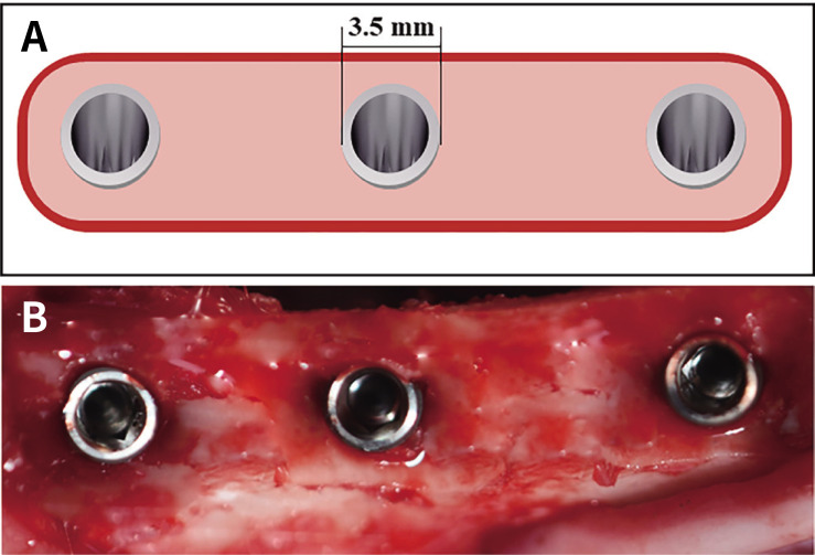Efficacy of plasma treatment for surface cleansing and osseointegration of sandblasted and acid-etched titanium implants.