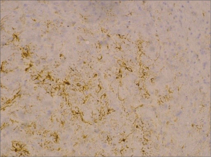 The effect of <i>Centella asiatica</i>, cinnamon, and spirulina as neuroprotective based on histopathological findings in ratus Sprague Dawley with traumatic brain injury.