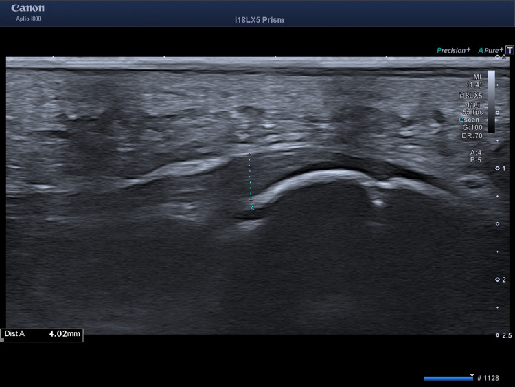 Combined Electromagnetic and Electrohydraulic Focused ESWT and EMTT for Delayed Calcaneal Union in an Adolescent Parkour Athlete - A Case Report.