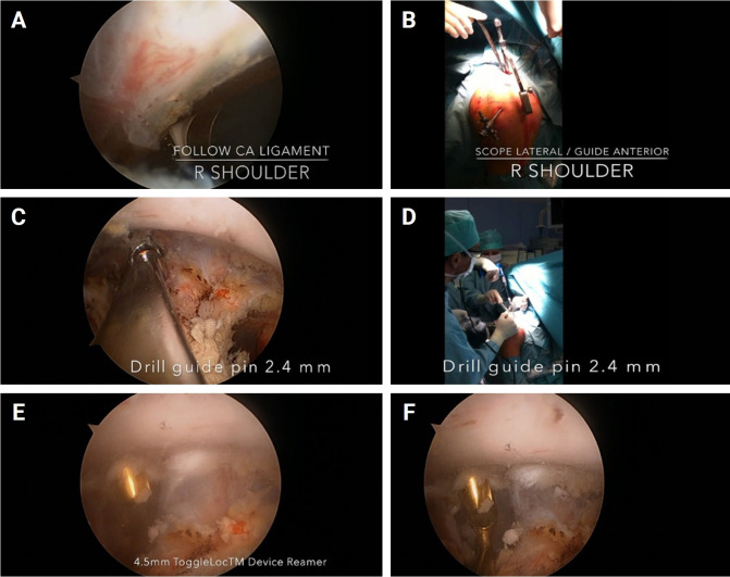 Long-term clinical and radiographic outcomes of arthroscopic acromioclavicular stabilization for acute acromioclavicular joint dislocation.