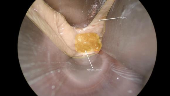 Laparoscopic transabdominal cerclage in a pregnant woman after fertility-sparing treatment for early-stage cervical cancer: an operative technique in ten steps.