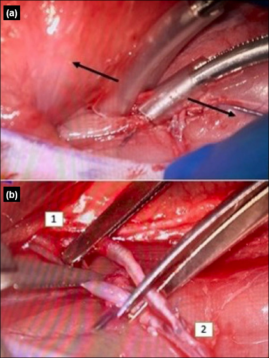 Evaluation of the effects of ectopic replantation on amputate survival in the management of crush traumatic amputations in rats: An experimental study.