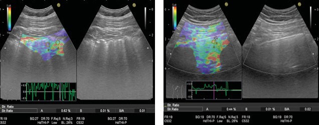 The role of lung ultrasound and ultrasound elastography in diagnosis of interstitial lung diseases.