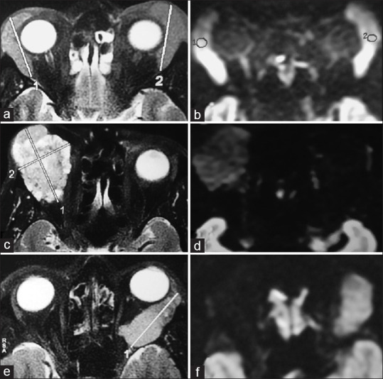Radiopathological Correlation in Orbital Lesions.