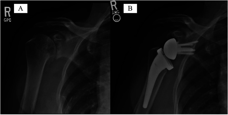 Short-Term Radiographic Outcomes of Bone Versus Metallic Augmented, Central Screw Type Baseplate in Reverse Total Shoulder Arthroplasty: Matched Case-Control Study.