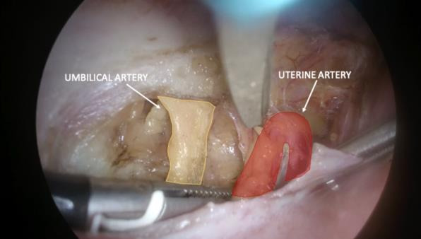 Laparoscopic transabdominal cerclage in a pregnant woman after fertility-sparing treatment for early-stage cervical cancer: an operative technique in ten steps.