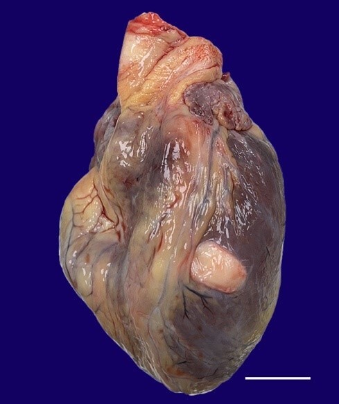 Incidental finding of cardiac hydatid cyst during autopsy.