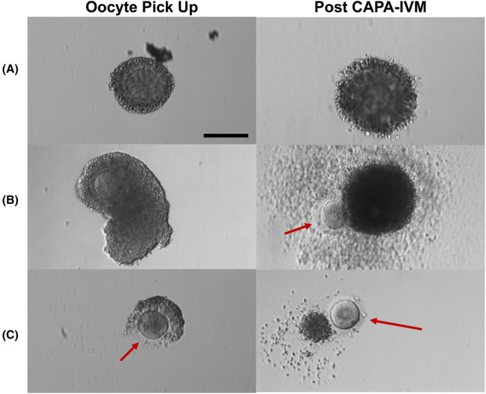 Effect of single versus grouped culture of human cumulus-oocyte complexes in PCOS women treated with biphasic in vitro maturation: A sibling oocyte pilot study.