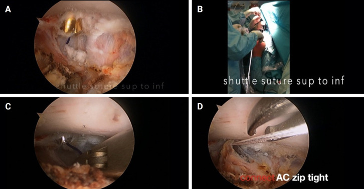 Long-term clinical and radiographic outcomes of arthroscopic acromioclavicular stabilization for acute acromioclavicular joint dislocation.