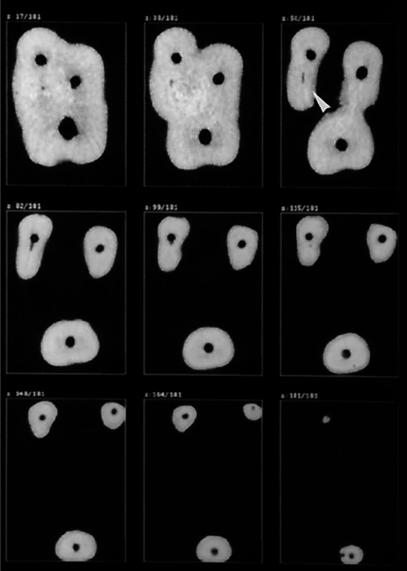 Quality of Root Canal Filling in Curved Canals Utilizing Warm Vertical Compaction and Two Different Single Cone Techniques: A Three-Dimensional Micro-Computed Tomography Study.