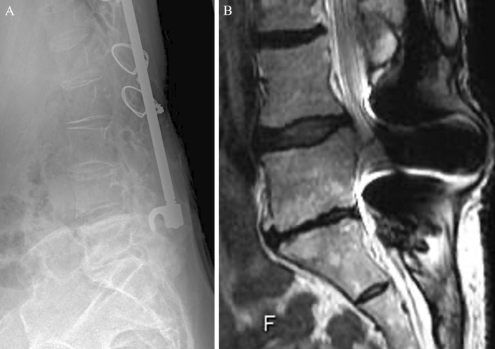 Intervertebral Disc Degeneration in Long-Term Postoperative Patients with Adolescent Idiopathic Scoliosis: MRI Evaluation 34-51 Years after Surgery and its Changes during Middle and Older Age for an Average of 6.9 Years.
