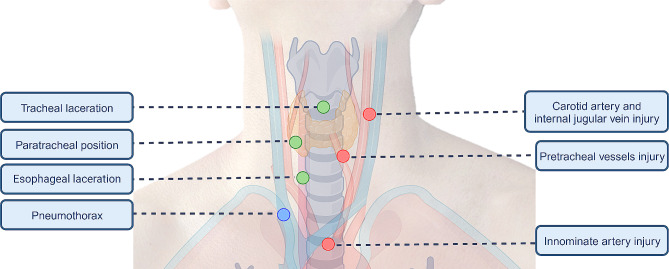 Ultrasound-guided percutaneous tracheostomy: a risk-based protocol.