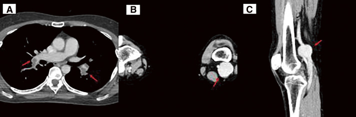 A Case of Popliteal Venous Aneurysm Diagnosed after Sudden Cardiac Arrest.