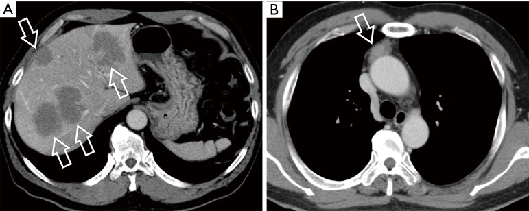 Imaging of thymic epithelial tumors-a clinical practice review.