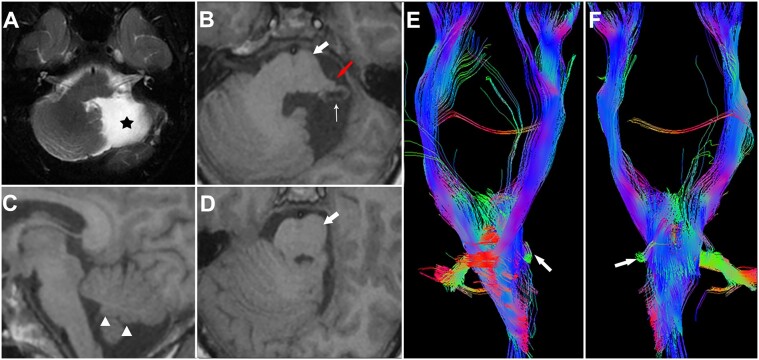 Is unilateral cerebellum sufficient? Insights from new cases of cerebellar agenesis and literature review.