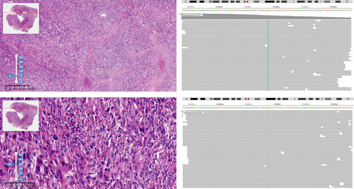 Predicting <i>MET</i> exon 14 skipping mutation in pulmonary sarcomatoid carcinoma by whole-tumour texture analysis combined with clinical and conventional contrast-enhanced computed tomography features.