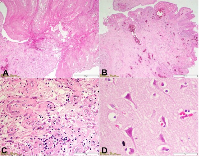 Fatal asphyxia due to large laryngeal granuloma.