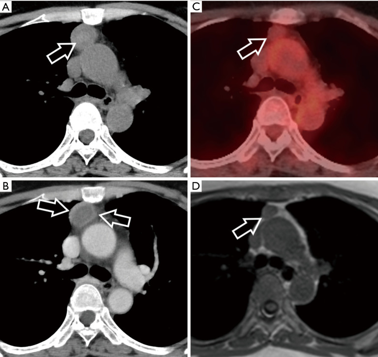 Imaging of thymic epithelial tumors-a clinical practice review.