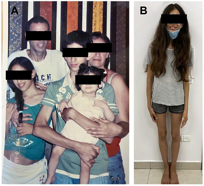 Autosomal Dominant, Long-Standing Dysglycemia in 2 Families with Unique Phenotypic Features.