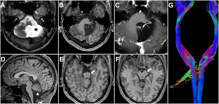 Is unilateral cerebellum sufficient? Insights from new cases of cerebellar agenesis and literature review.