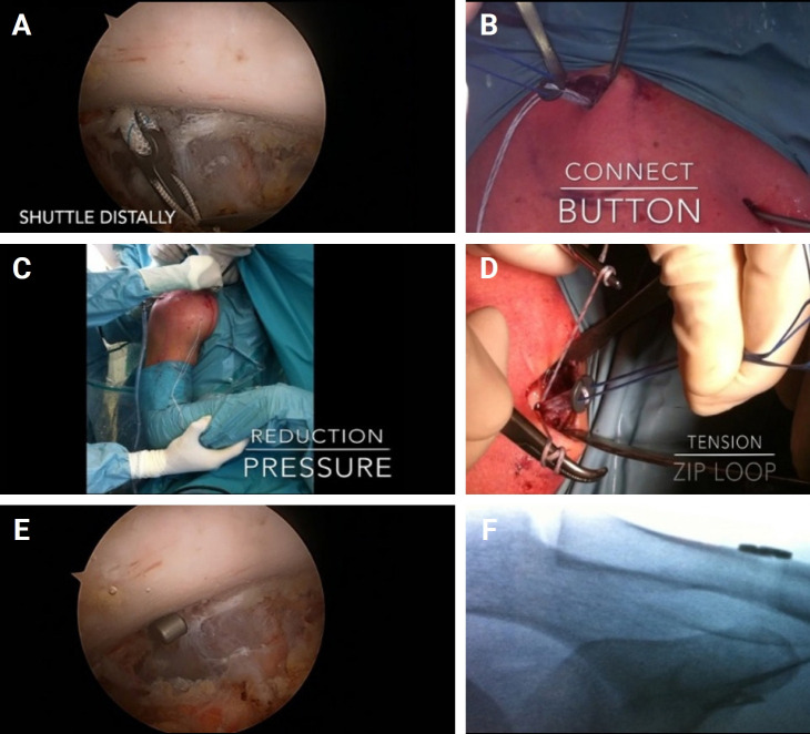 Long-term clinical and radiographic outcomes of arthroscopic acromioclavicular stabilization for acute acromioclavicular joint dislocation.