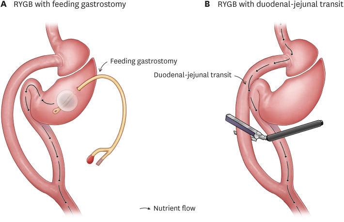 Enteroendocrine Reprogramming by Altered Epithelial-Mesenchymal Crosstalk in Metabolic Surgery.