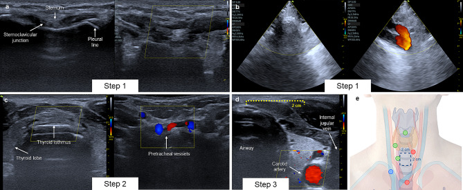 Ultrasound-guided percutaneous tracheostomy: a risk-based protocol.