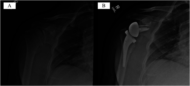 Short-Term Radiographic Outcomes of Bone Versus Metallic Augmented, Central Screw Type Baseplate in Reverse Total Shoulder Arthroplasty: Matched Case-Control Study.
