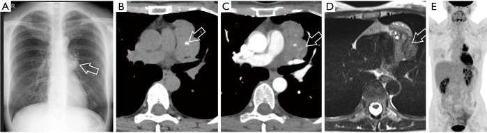Imaging of thymic epithelial tumors-a clinical practice review.