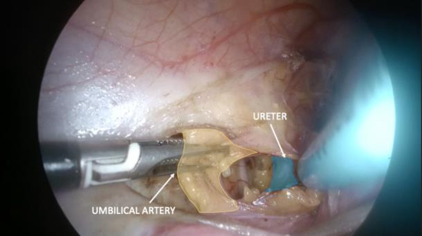 Laparoscopic transabdominal cerclage in a pregnant woman after fertility-sparing treatment for early-stage cervical cancer: an operative technique in ten steps.