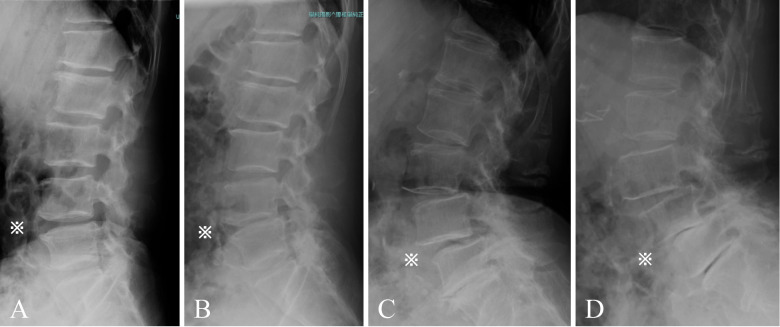 Analysis of Risk Factors for Postoperative Progressive Segment Degeneration at the Decompression and Non-decompression Segments after Minimally Invasive Lumbar Decompression Surgery: A 5-year Follow-up Study.