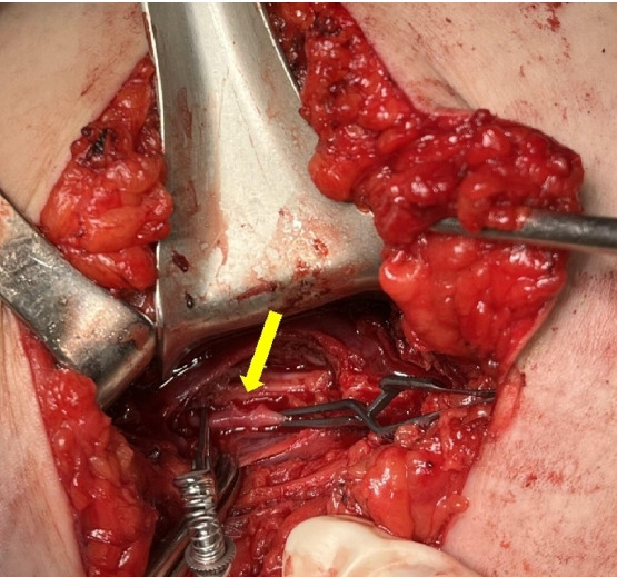 Experiencing cardiac arrest during surgical exploration in hemodynamically stable patients with multiple stab wounds, including lower extremity in Korea: a case report.