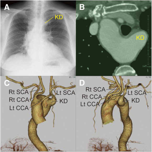 Right Carotid Artery Origin Compression Caused by Endovascular Repair for Kommerell Diverticulum Associated with a Right-Sided Aortic Arch.