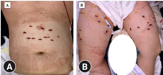 Experiencing cardiac arrest during surgical exploration in hemodynamically stable patients with multiple stab wounds, including lower extremity in Korea: a case report.
