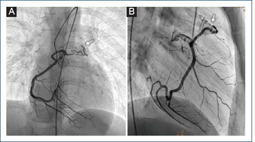 [Double coronary fistula: a rare finding in a pediatric patient].