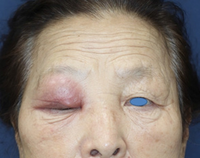Pott's puffy tumor of the upper eyelid misdiagnosed as simple abscess: a case report and literature review.