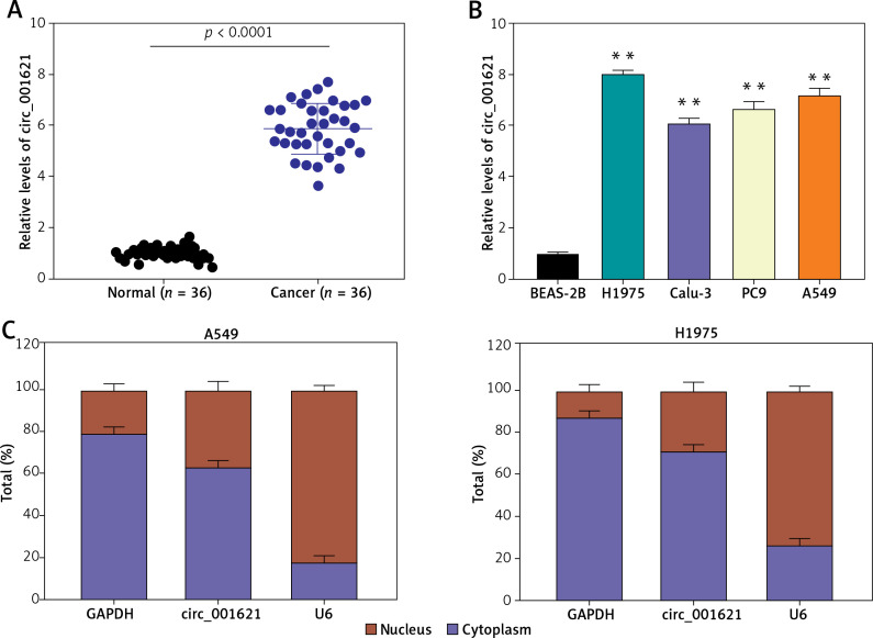 Circular RNA circ_001621 acts as a tumor promoter in lung cancer by regulating the miR-199a-3p/GREM1 axis.