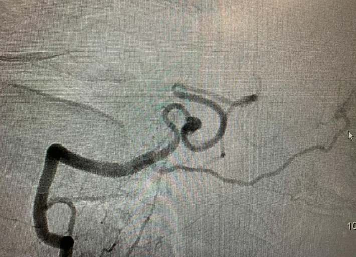 Management of a ruptured posterior inferior cerebellar artery (PICA) aneurysm with end-to-end in situ bypass: Case report.