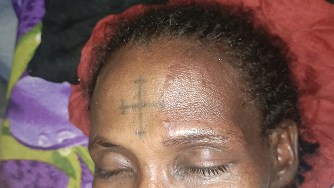 An Atypical Seizure Onset and Re-Emergence in a Refugee with an Undiagnosed Sturge-Weber Syndrome: A Case Report from a Limited Setting.