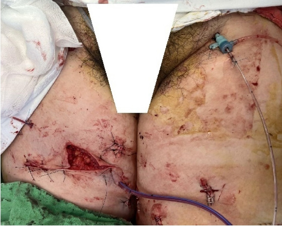 Experiencing cardiac arrest during surgical exploration in hemodynamically stable patients with multiple stab wounds, including lower extremity in Korea: a case report.