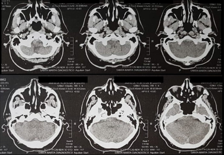 Management of a ruptured posterior inferior cerebellar artery (PICA) aneurysm with end-to-end in situ bypass: Case report.