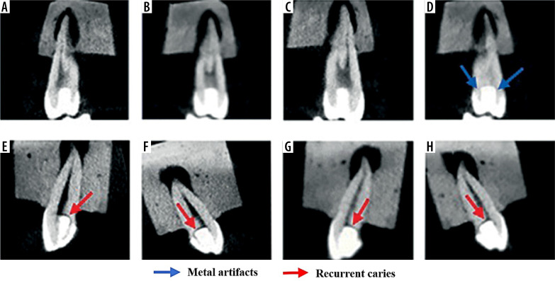 Performance of different cone-beam computed tomography scan modes with and without metal artifact reduction in detection of recurrent dental caries under various restorative materials.