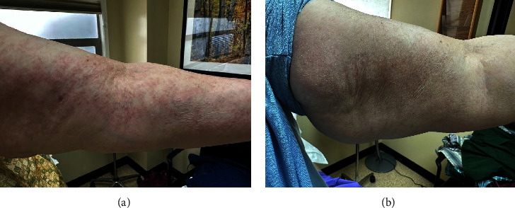 Successful Treatment of Refractory Generalized Granuloma Annulare with Upadacitinib.