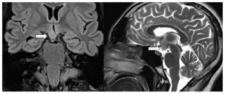 Gyratory Seizures in Hypothalamic Hamartoma.