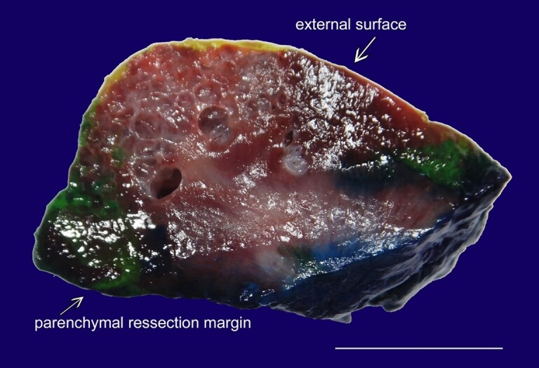 Localized cystic kidney disease: a case report unveiling clinical and histopathological challenges.